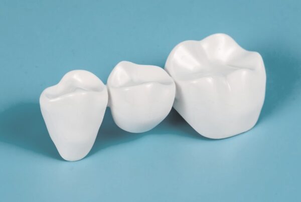 puentes-dentales-tratamiento