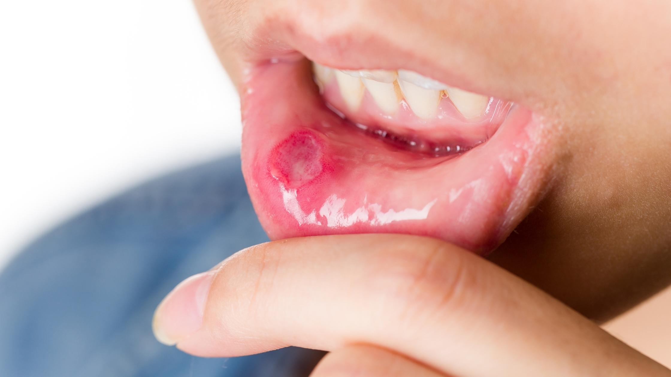Asser Corteza isla Llagas en la boca o aftas bucales ⋆ Clínica Dental CEMEQ