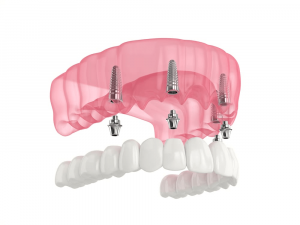 implantes-dentales-carga-inmediata