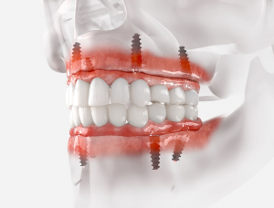 implantes-dentales.valencia