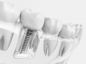 implante-dental-precio-valencia -CEMEQ