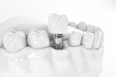 prótesis dentales fijas