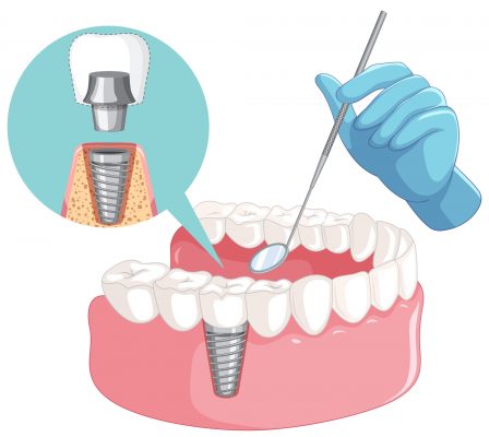 En CEMEQ encontrarás los mejores implantes dentales precios