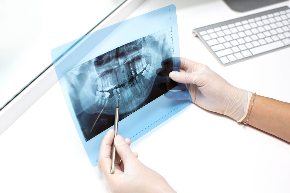 En CEMEQ encontrarás el mejor implante dental precio