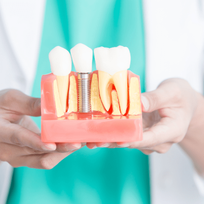 Implante dental preco en CEMEQ